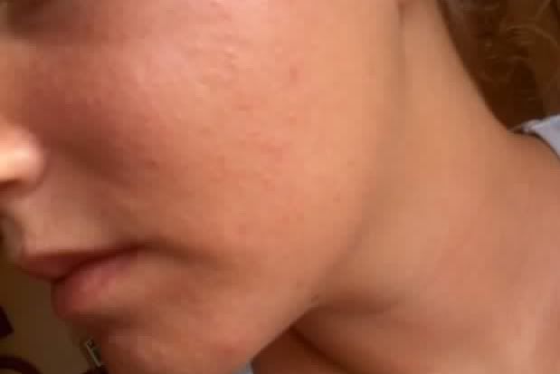 Red Bump on Face - Dermatology - MedHelp
